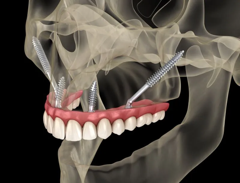 Can I get implants if I have severe bone loss? Learn how zygomatic implants make dental implants possible even in advanced bone loss cases, without bone grafting.