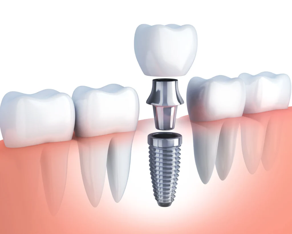 So, how much do dental implants cost in Albania in practical terms?