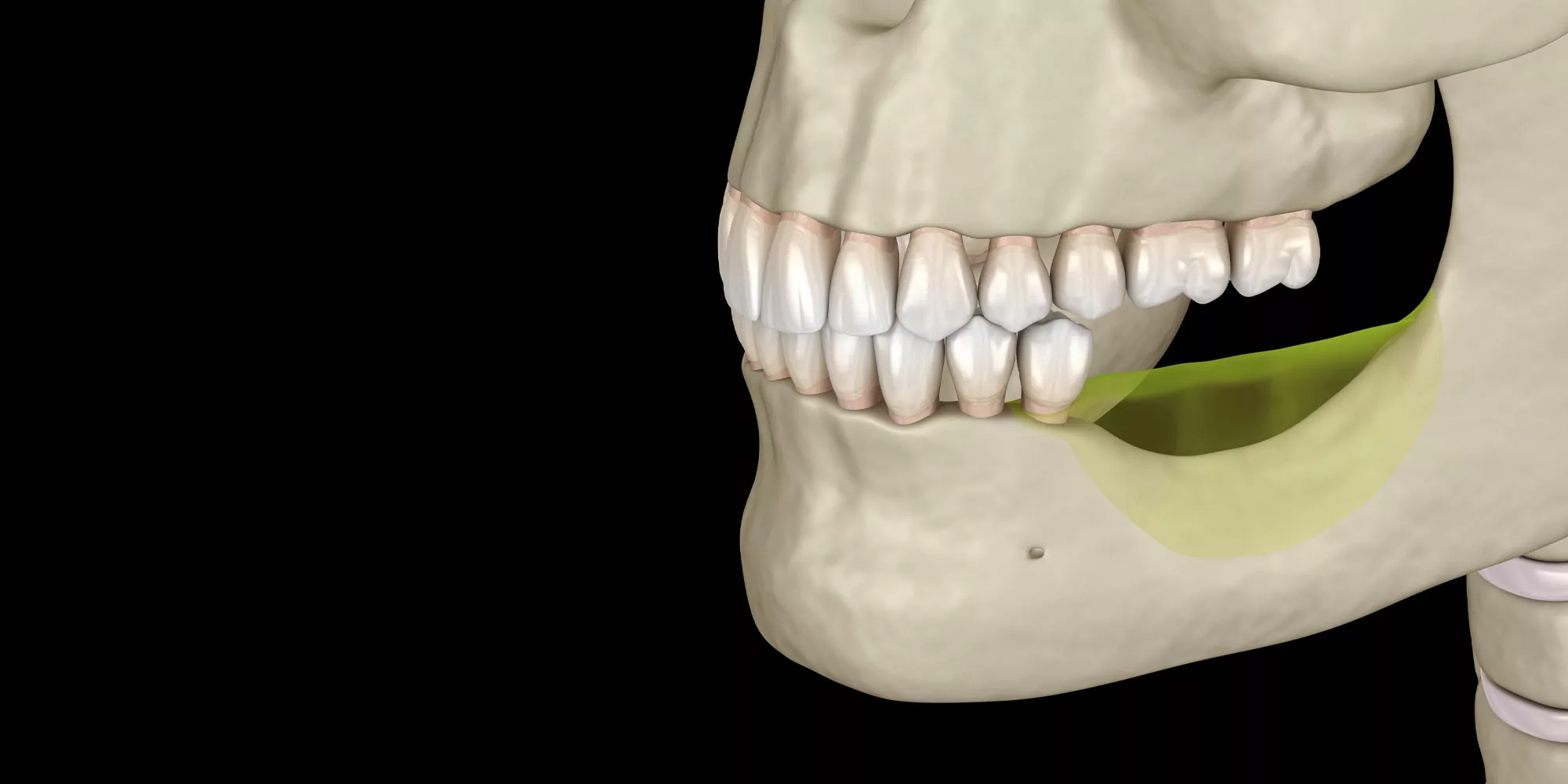 In the upper jaw, bone loss can be particularly severe because the bone is naturally softer and thinner. When bone volume is insufficient, traditional implants cannot achieve the stability required for long-term success.