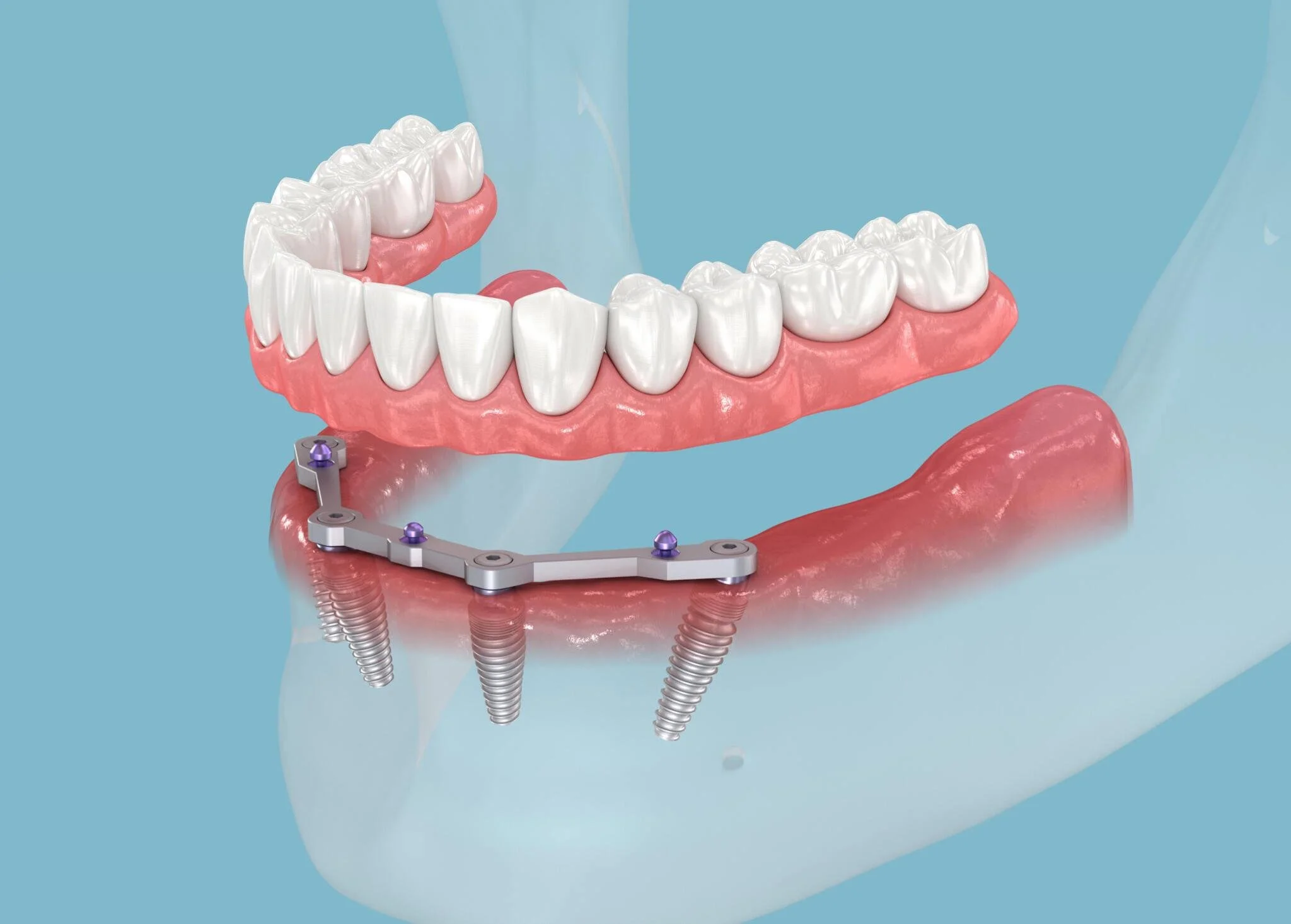 All-on-4 Dental Implants in Albania at Sota Dental provide a fixed full-arch solution using four implants for immediate stability, natural aesthetics, and long-term function at competitive prices.