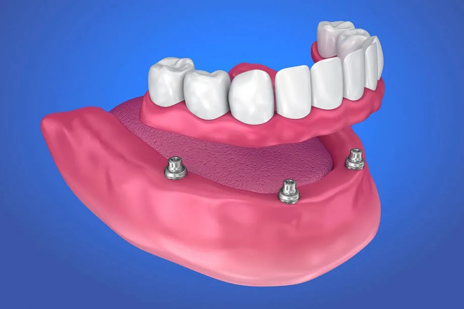 Le protesi supportate da impianti in Albania presso Sota Dental offrono soluzioni stabili e durature per il restauro dei denti, con una qualità superiore e a costi competitivi.