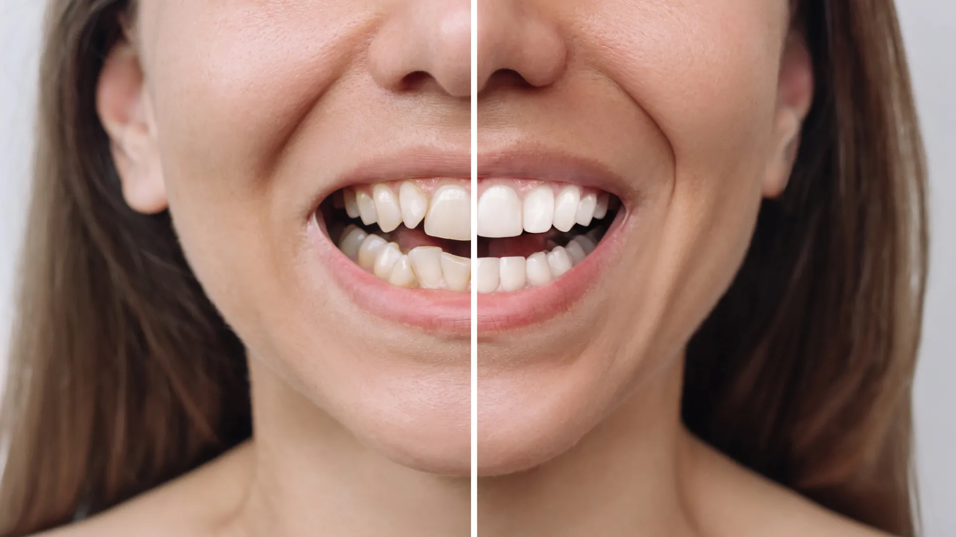 Comparison of smoker teeth and healthy dental implant results
