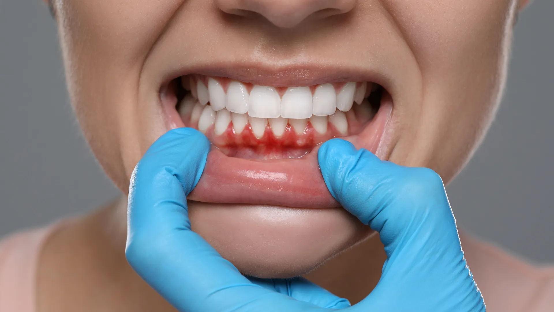 Healing dental implant in gums after placement