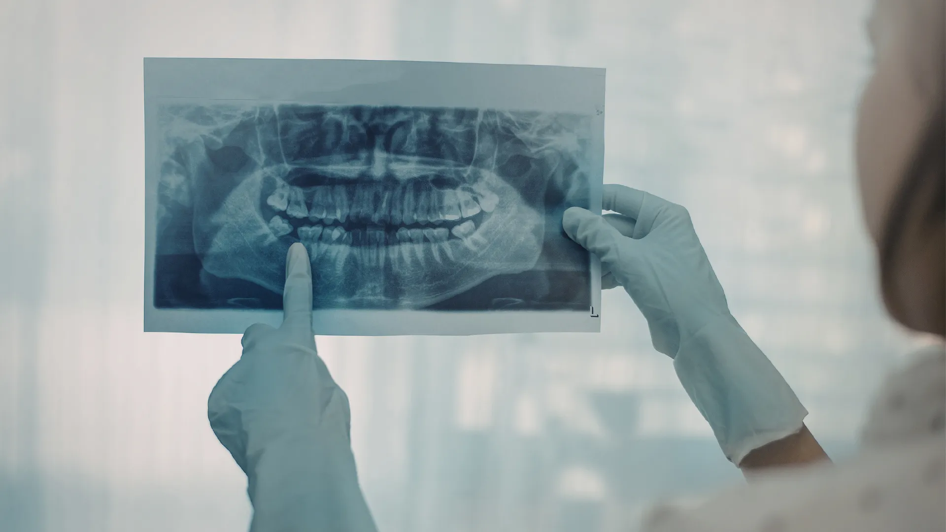 How long do dental implants really last explained with 3D dental model