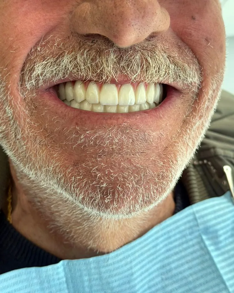 Happy UK retirees smiling confidently after full mouth dental implants