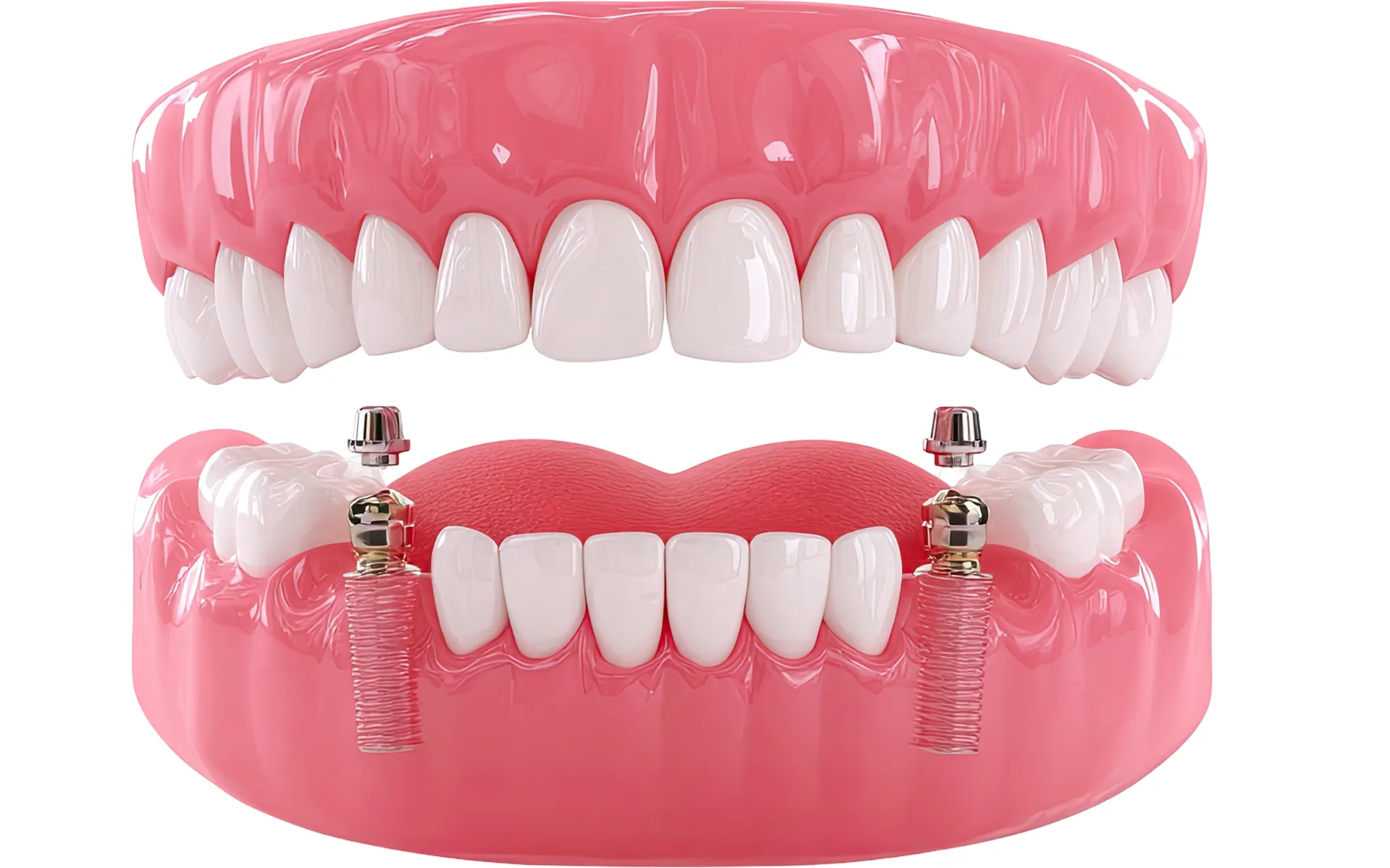 Replace dentures with fixed teeth UK comparison dentures vs dental implants Europe
