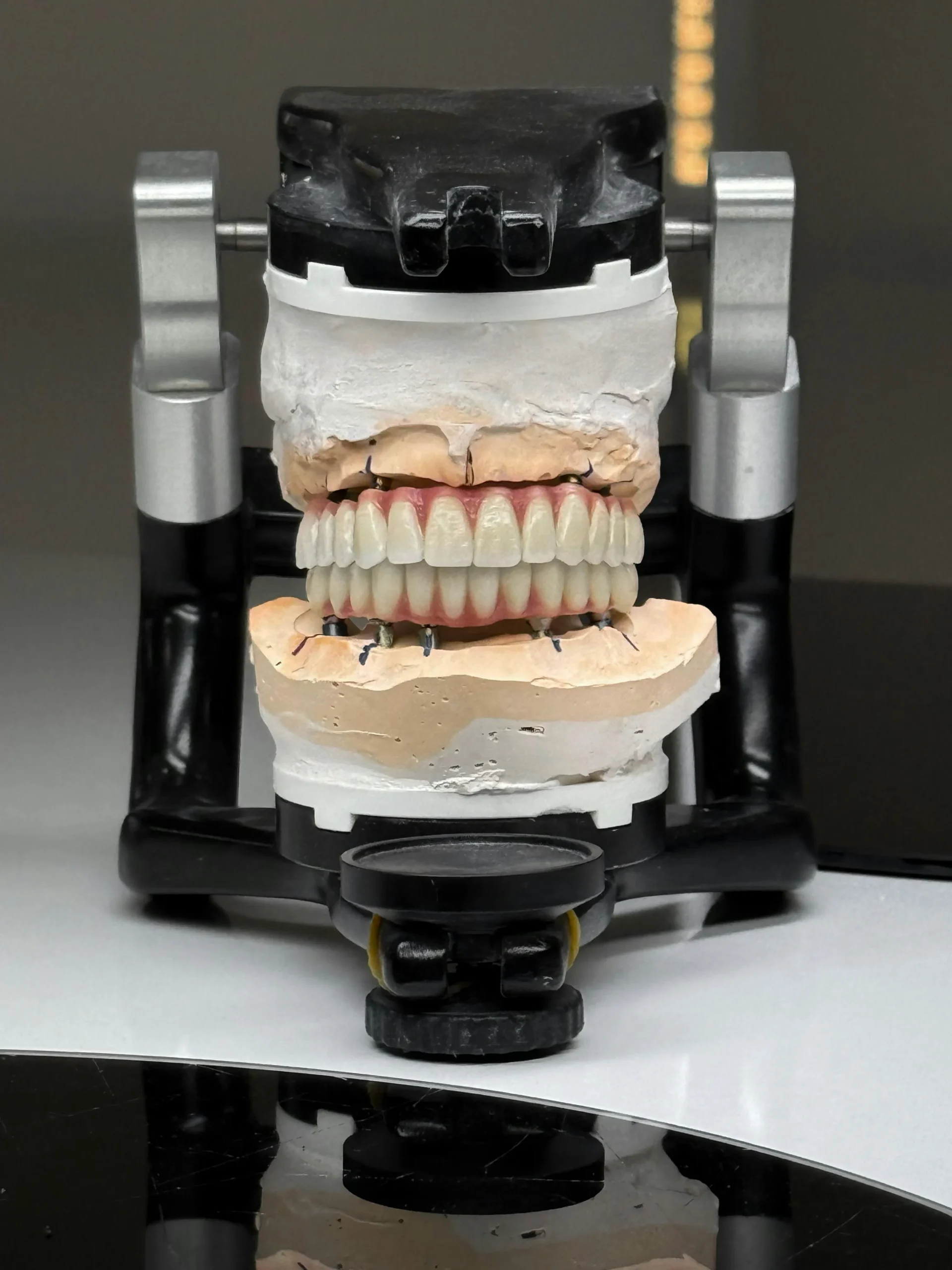 Full mouth restoration result natural smile UK patient alternative