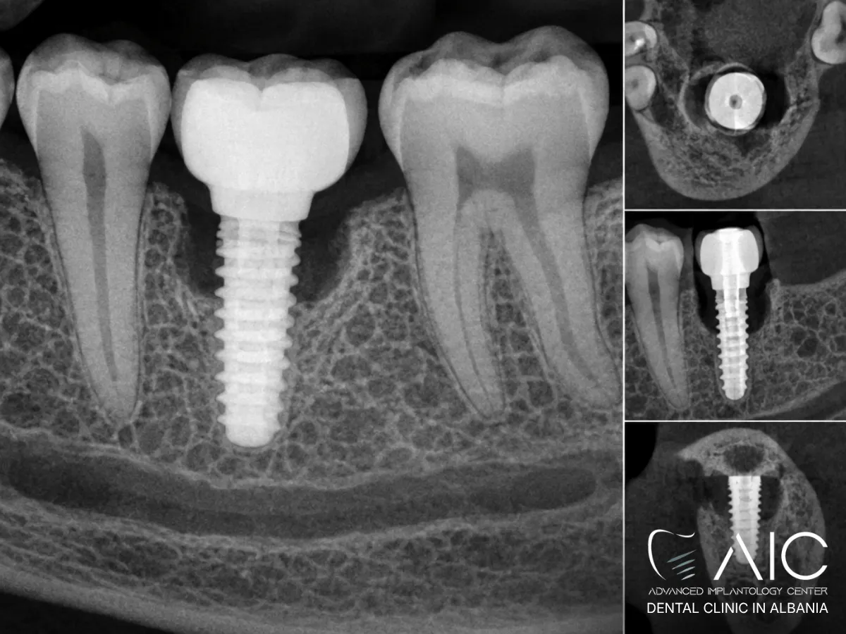 Dental X-ray showing crestal bone loss around a titanium implant affected by peri-implantitis
