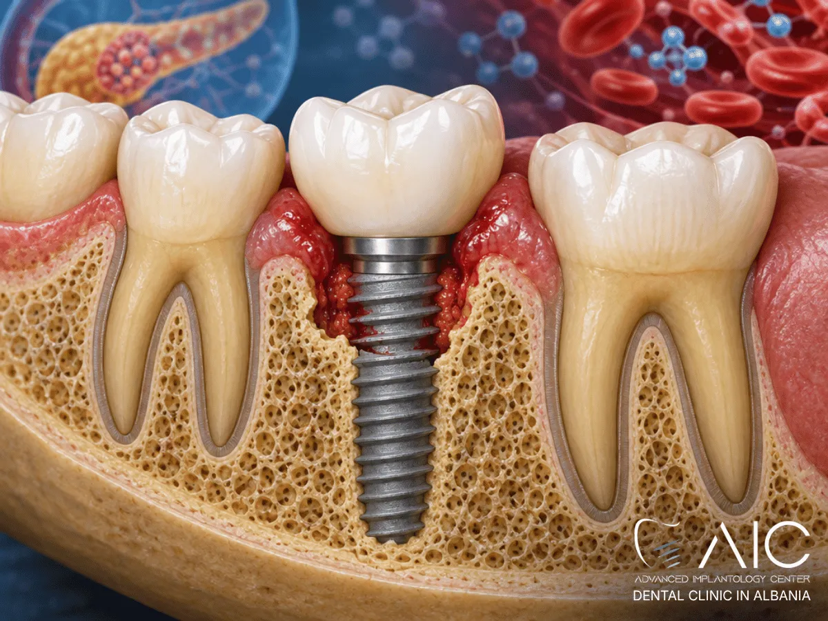 Peri-implantite con infiammazione gengivale e perdita ossea intorno a un impianto dentale