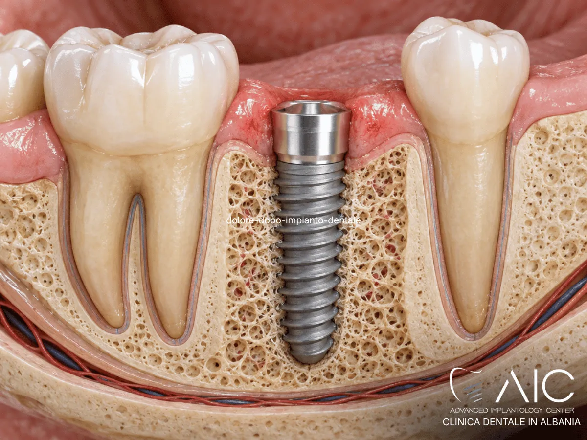 Dolore e normale infiammazione post-operatoria dopo il posizionamento di un impianto dentale