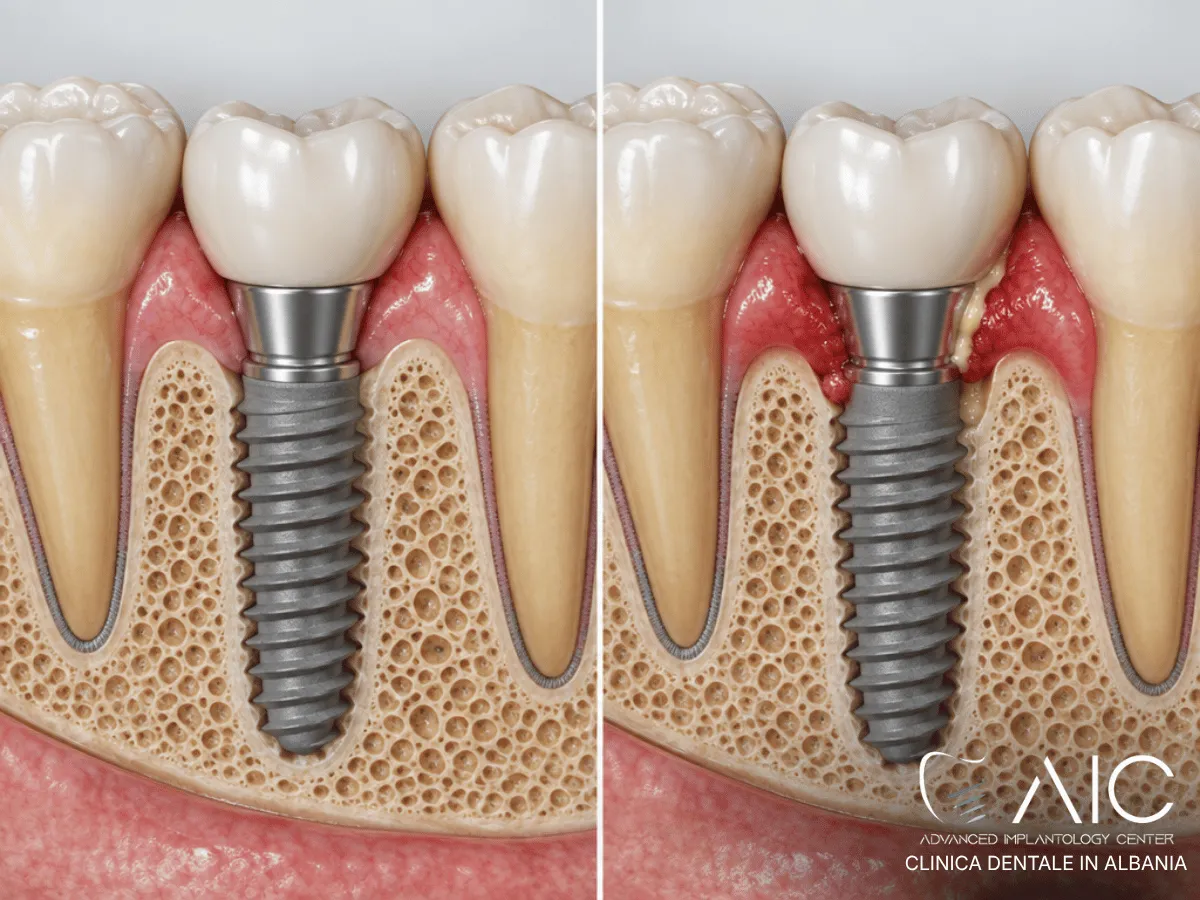 Confronto tra normale dolore post-operatorio e possibile complicazione dopo un impianto dentale