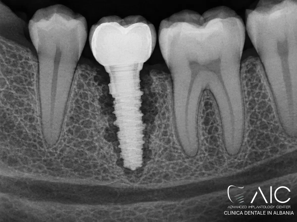 Radiografia di un impianto dentale con radiotrasparenza peri-implantare e perdita ossea