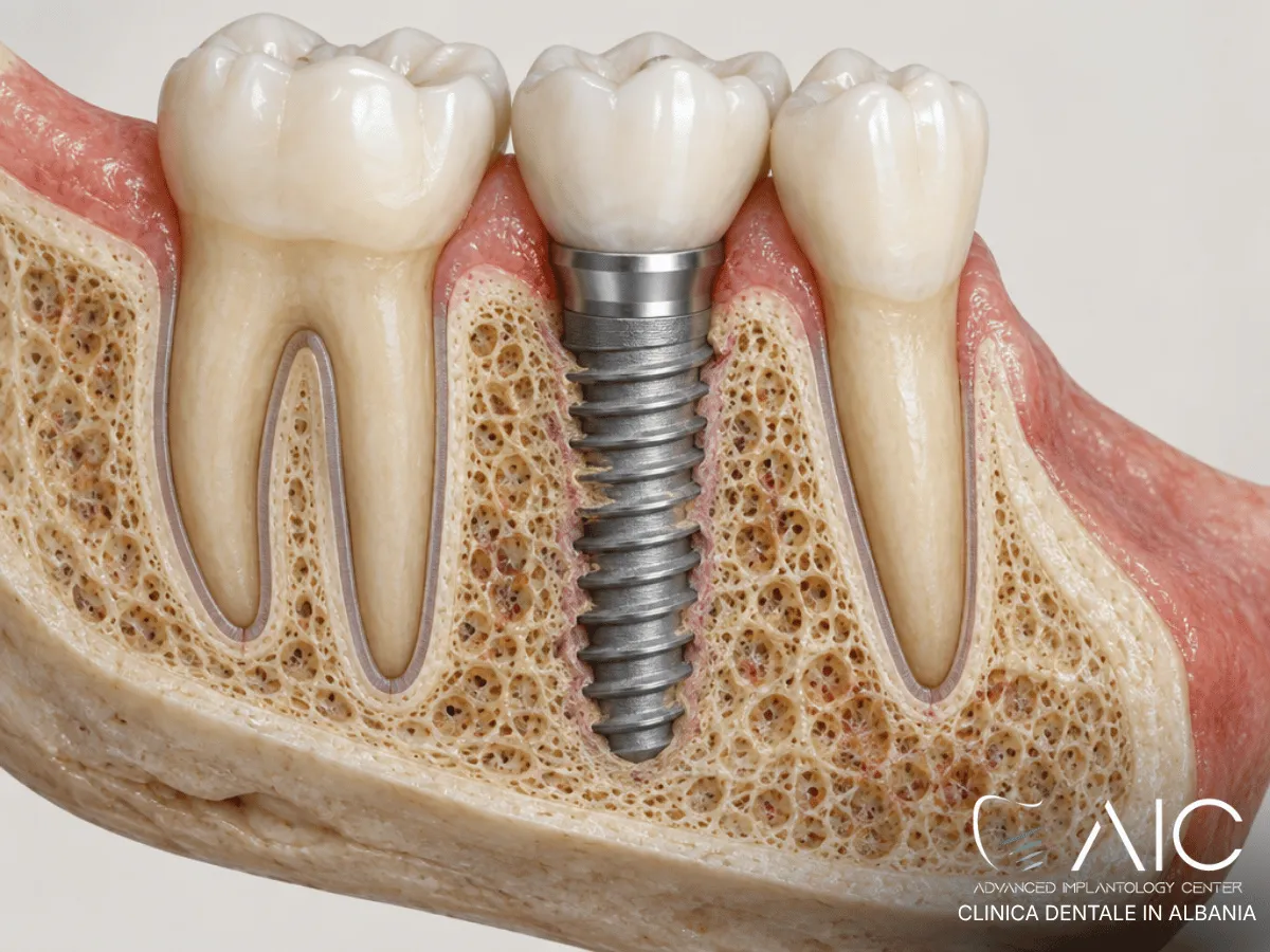 Impianto dentale con osseointegrazione incompleta e ridotto contatto tra osso e superficie implantare