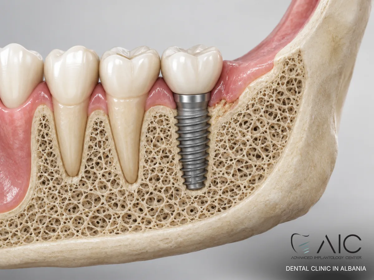 3D illustration of jawbone healing around a dental implant and localized MRONJ-related bone changes
