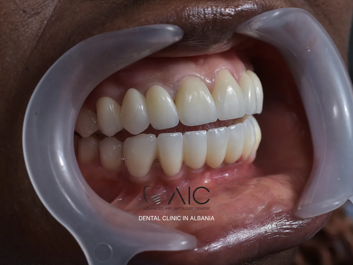 Pain after dental implant shown as mild inflammation around a titanium implant in the jawbone