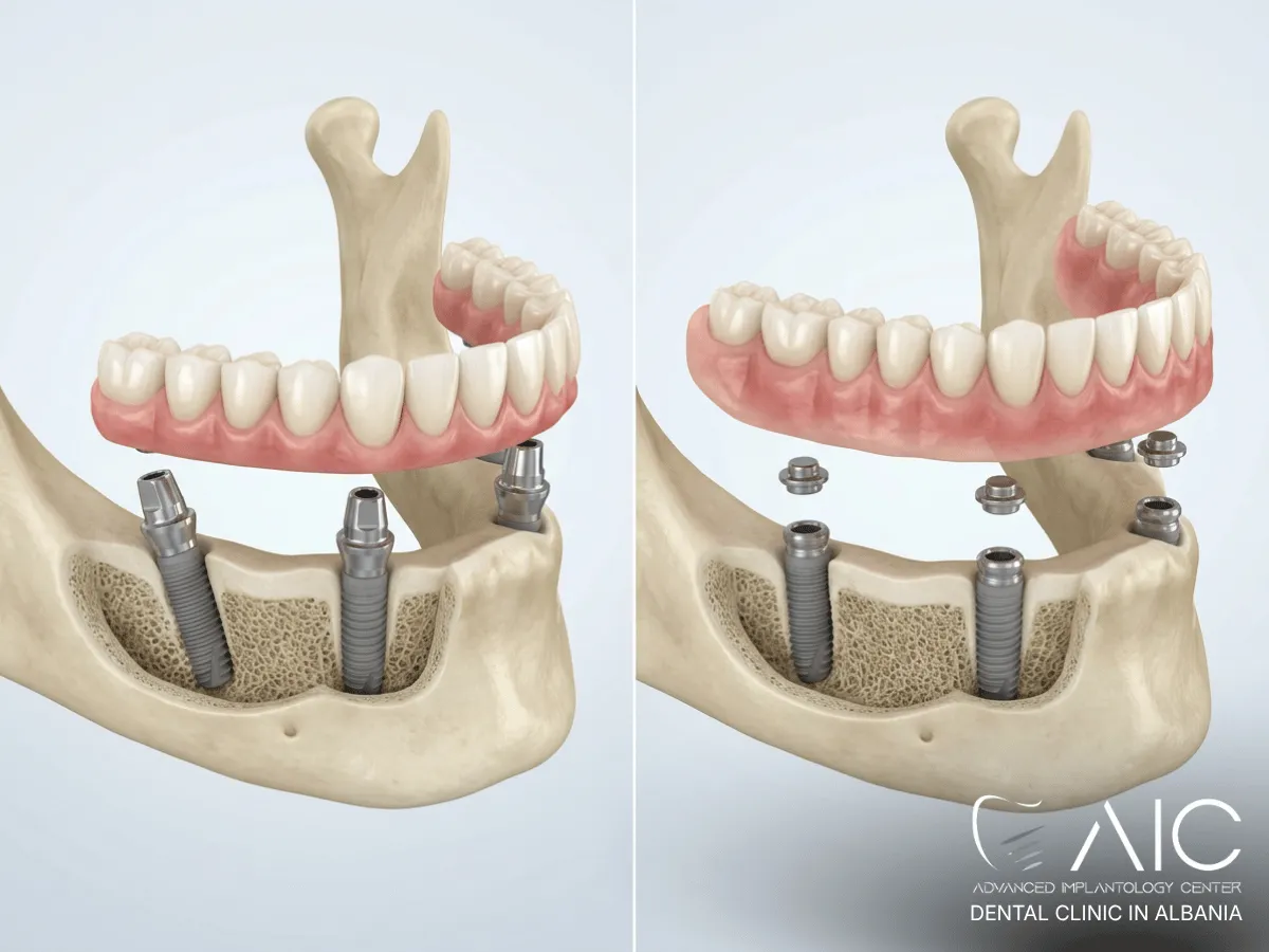 All-on-4 fixed implant teeth compared with a removable implant overdenture