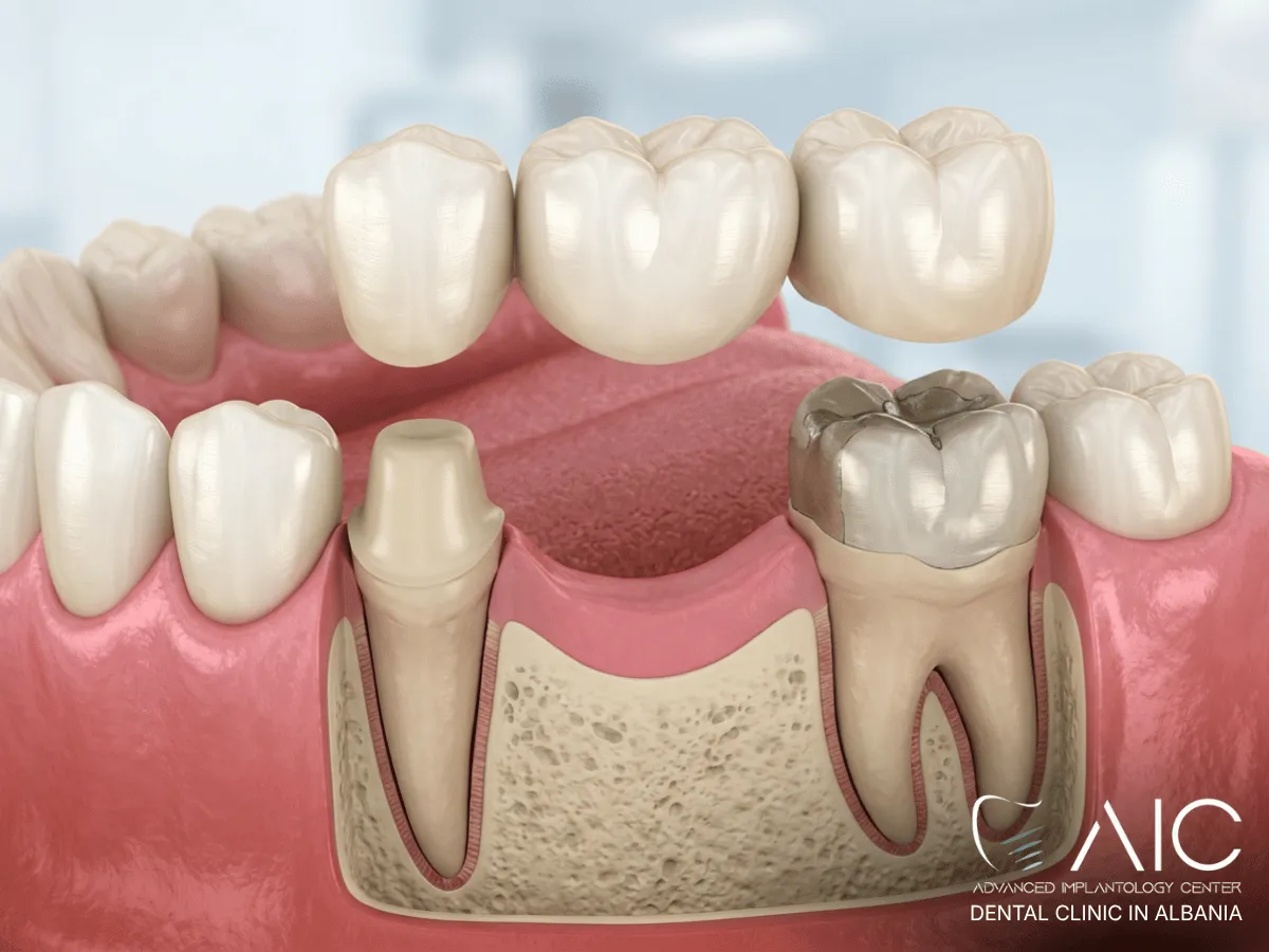 Three-unit dental bridge replacing one missing tooth between heavily restored adjacent teeth