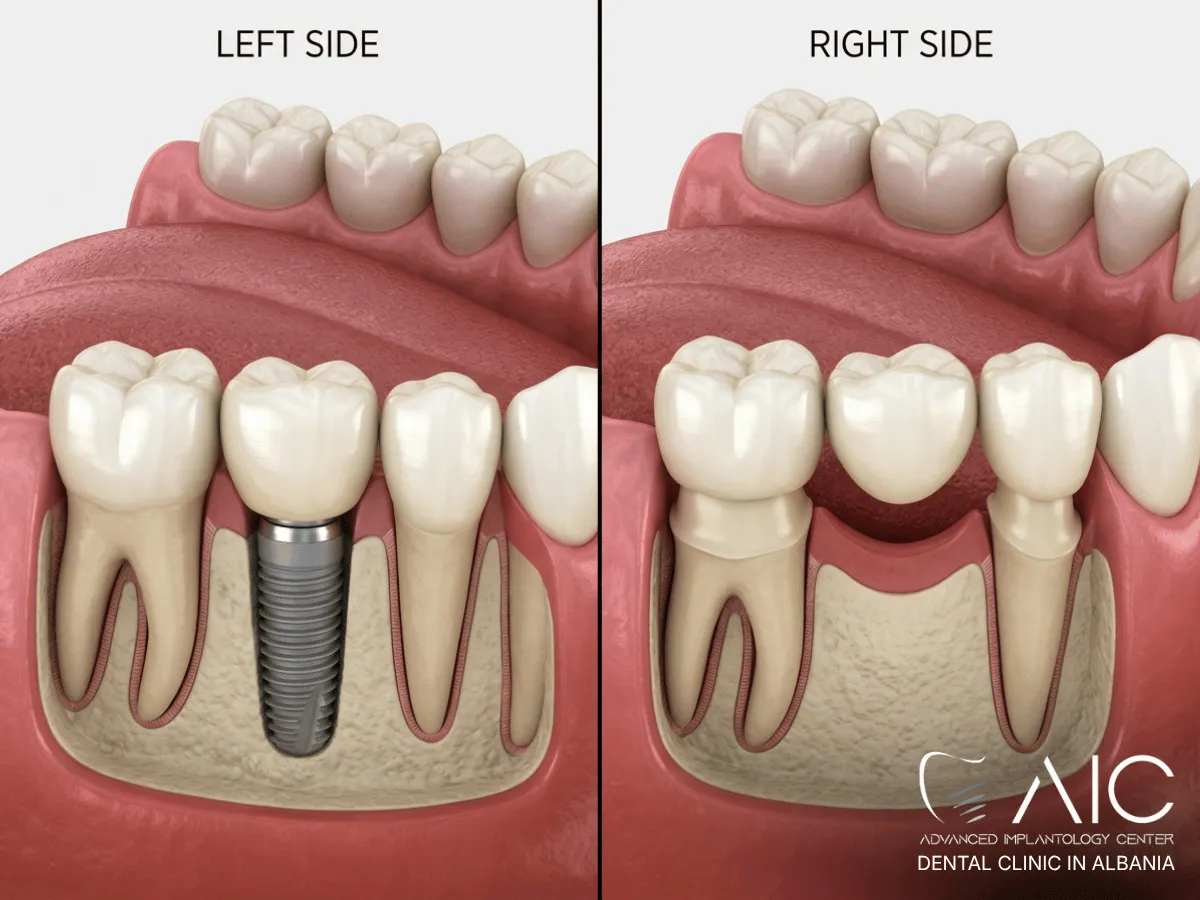 Dental implant compared with a traditional bridge for replacing one missing tooth