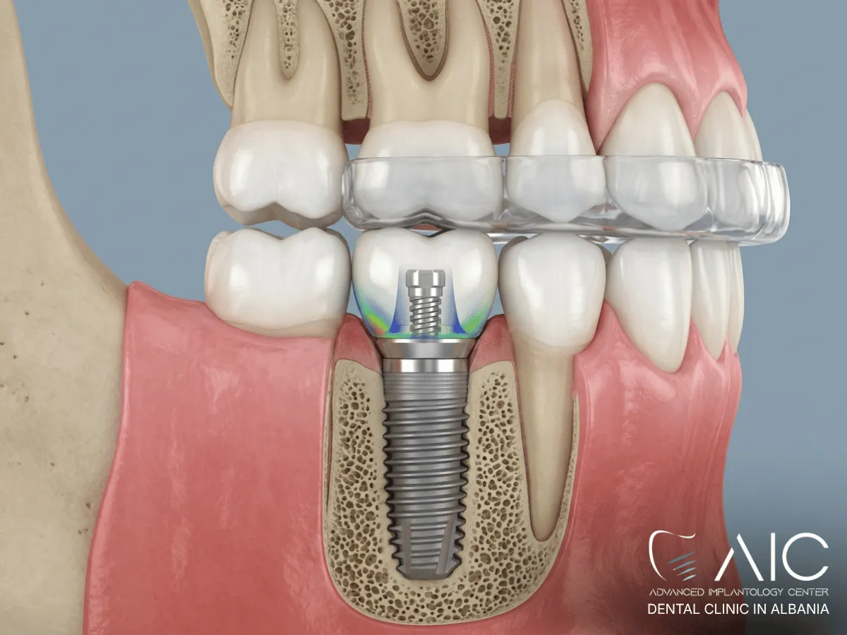 Dental implant under excessive teeth-grinding forces with a protective night guard