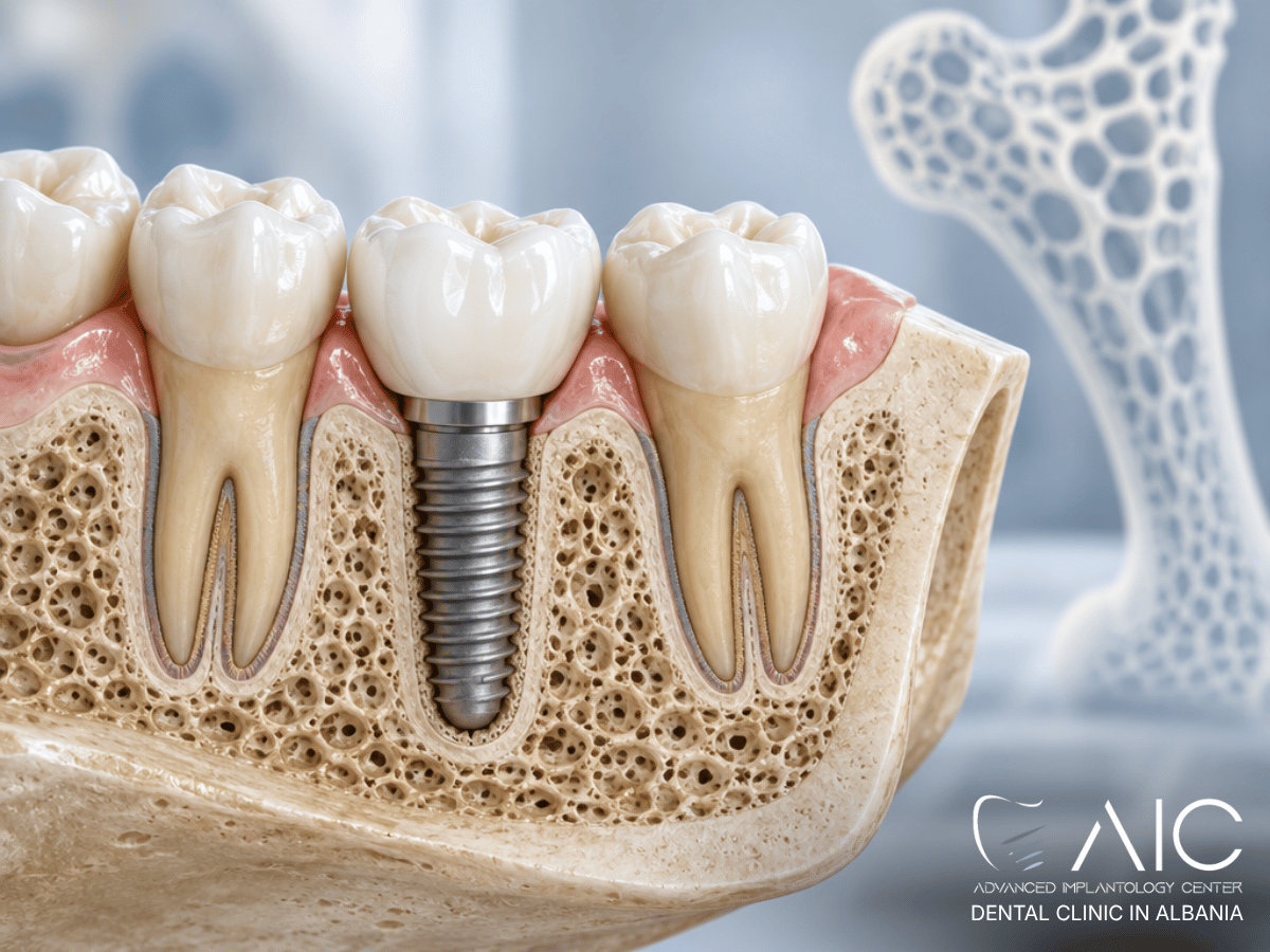 Dental implant successfully integrated in healthy jawbone in an older adult