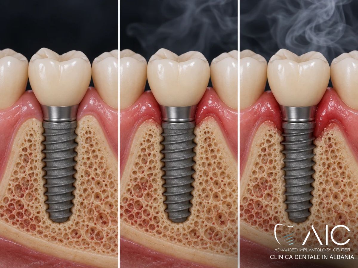 Fumo e perdita ossea intorno agli impianti dentali