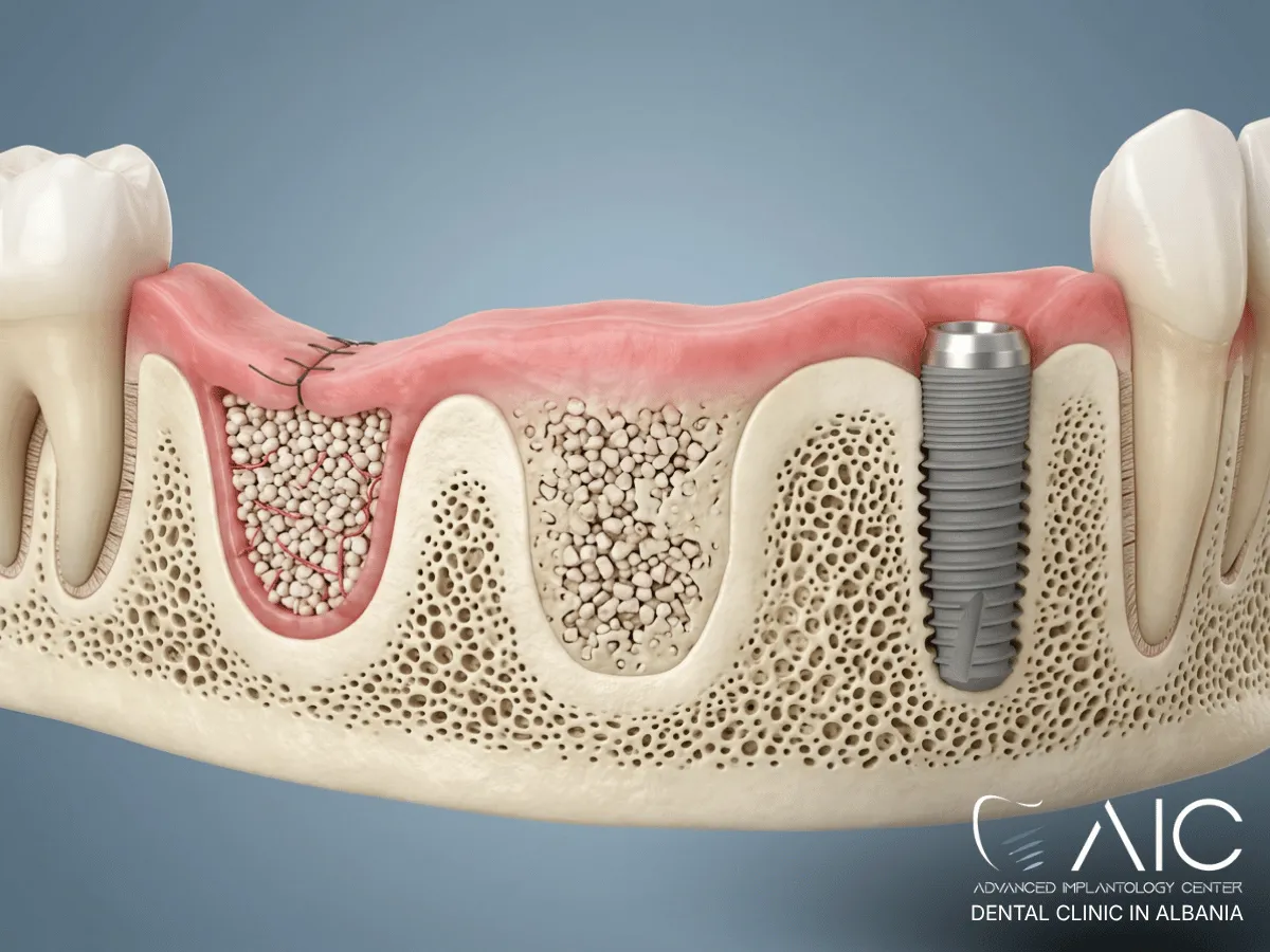 Dental bone graft healing and maturing before dental implant placement