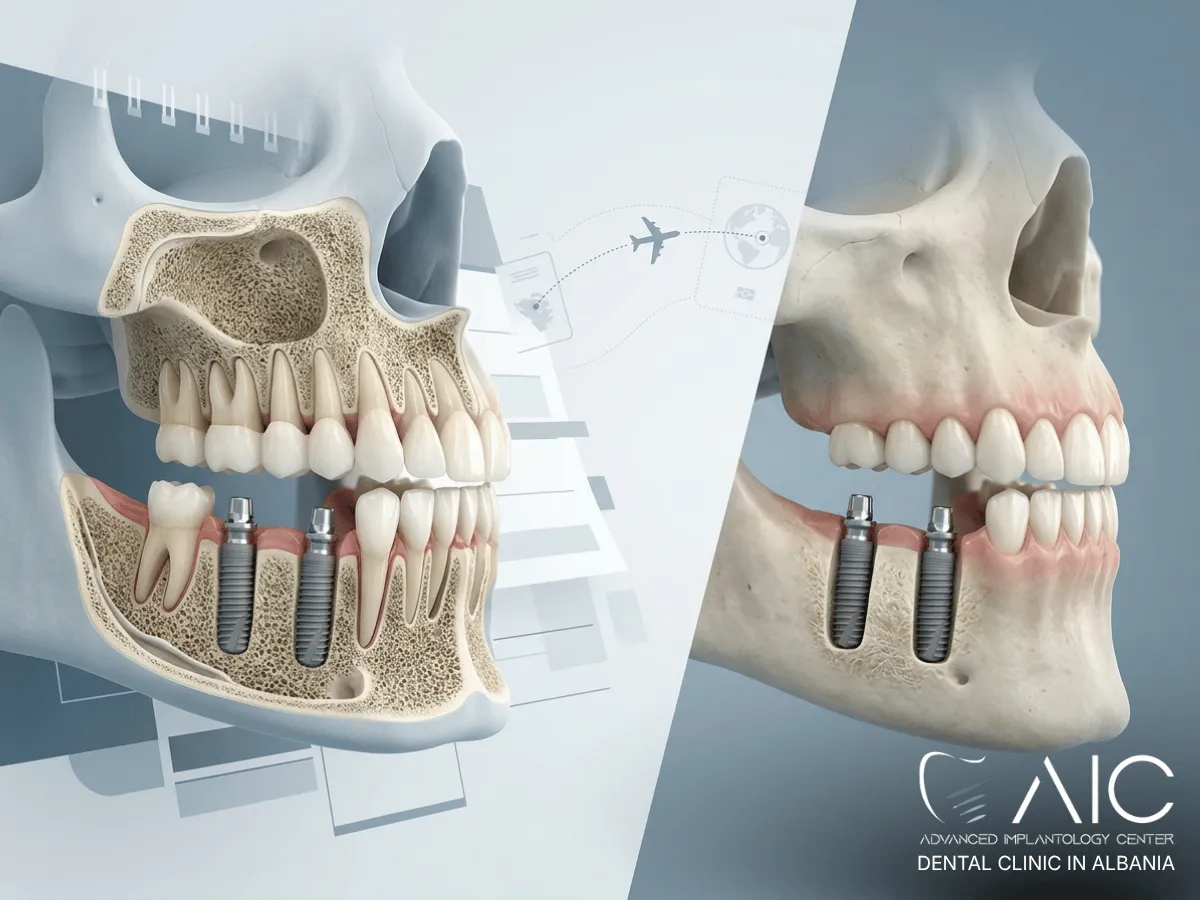 Dental implant treatment abroad showing implant surgery, healing period and final teeth across two trips