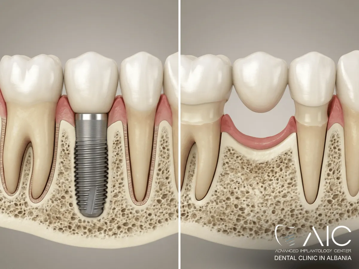 Dental implant anchored in jawbone compared with a bridge spanning a missing tooth space
