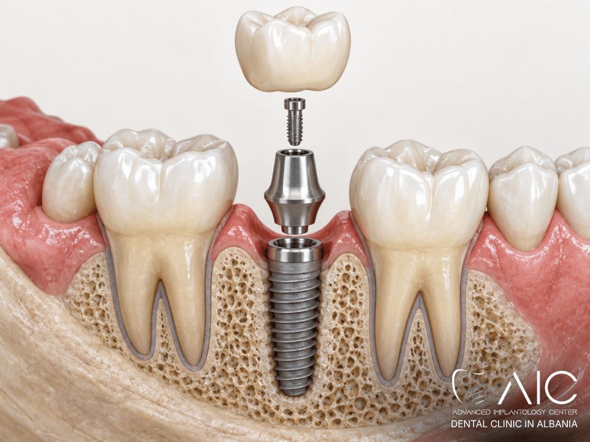 Dental implant showing crown, abutment screw and implant fixture as possible sources of movement