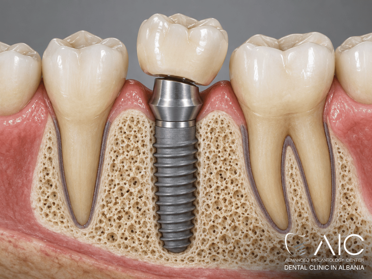 Loose implant crown with the titanium dental implant still stable and osseointegrated in bone