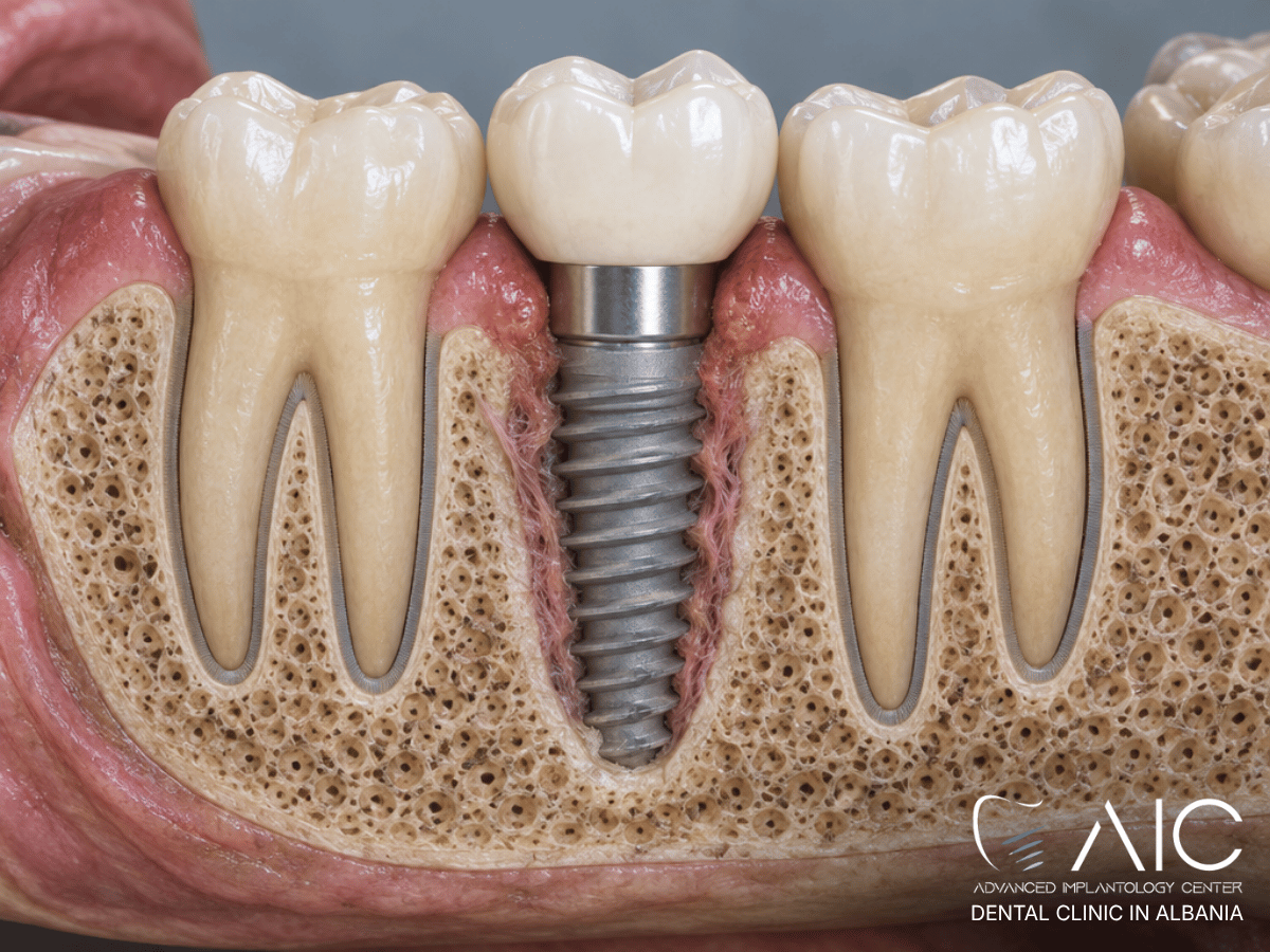 Mobile dental implant with failed osseointegration and reduced bone-to-implant contact