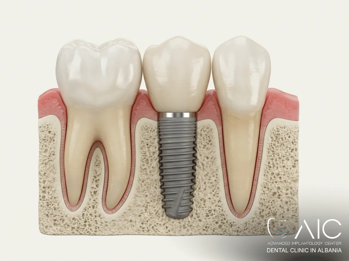 Single dental implant replacing a missing tooth while preserving healthy neighboring teeth