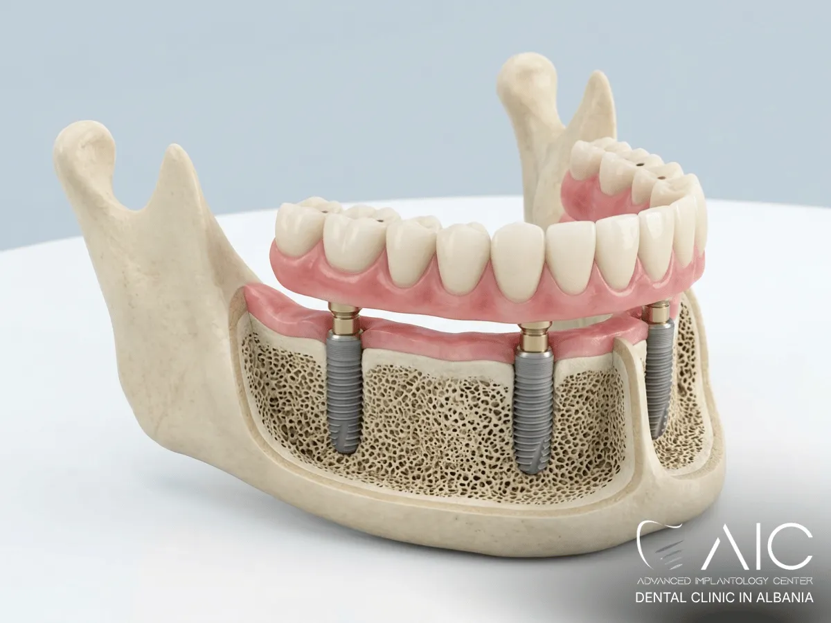 Fixed temporary implant bridge supported by dental implants during the healing phase