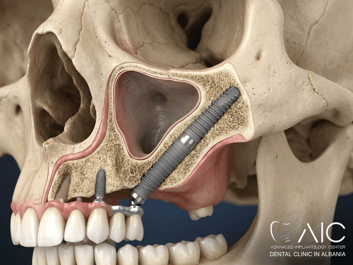 Zygomatic implant anchored in the cheekbone for severe upper jaw bone loss